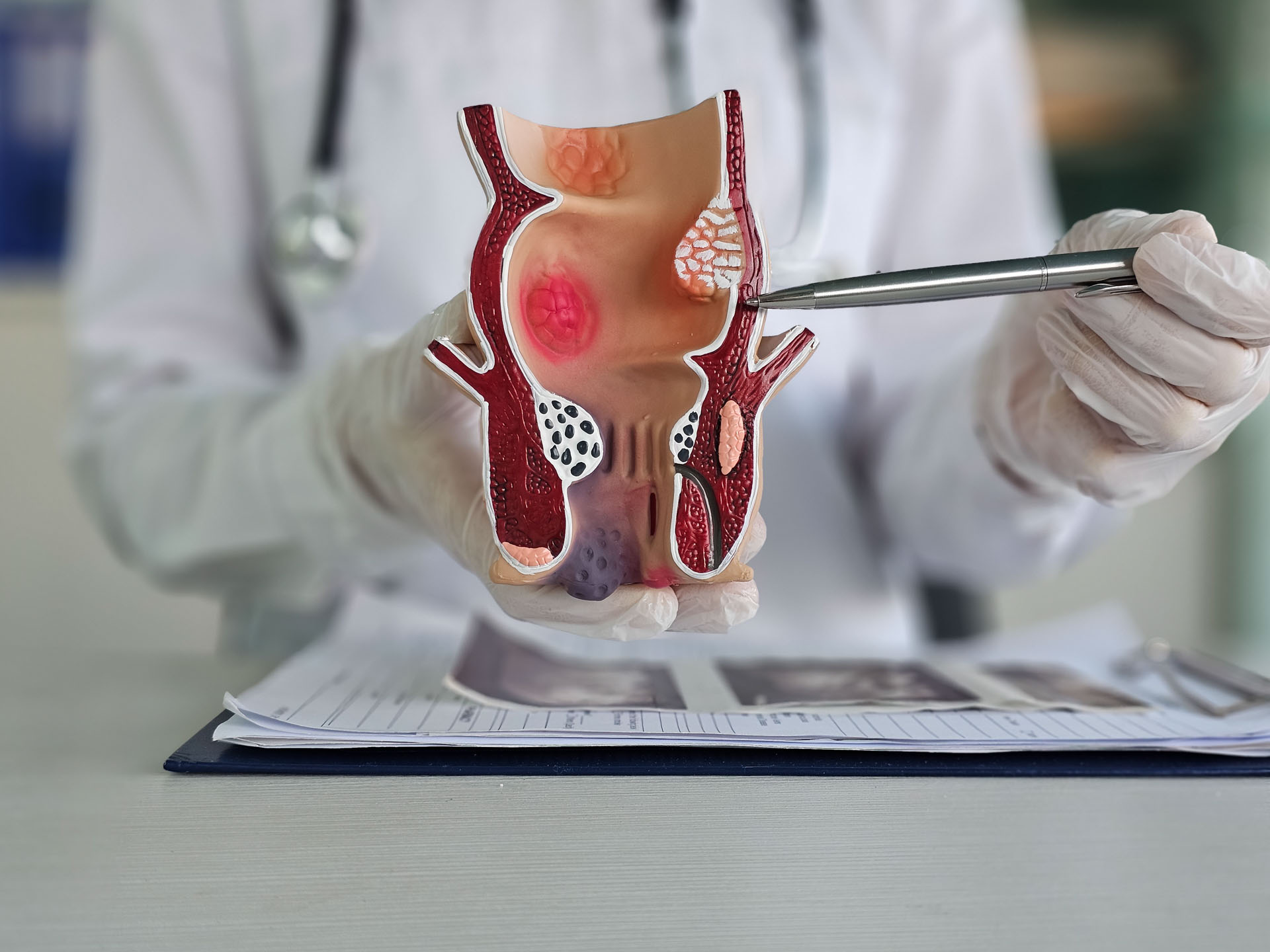 Medizinische Darstellung von Erkrankungen des Rektums an einem künstlichen Modell eines menschlichen Organs